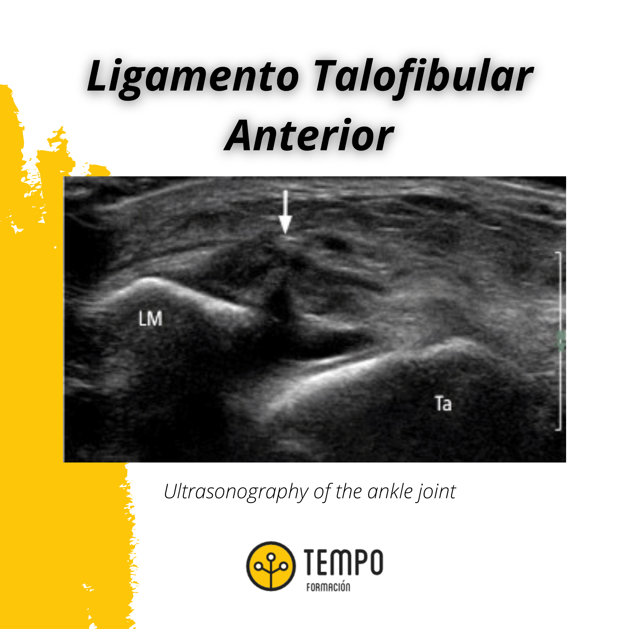 Ligamento talofibular anterior tempo formacion.png